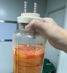 渠县水动力吸脂手术要做多久？
